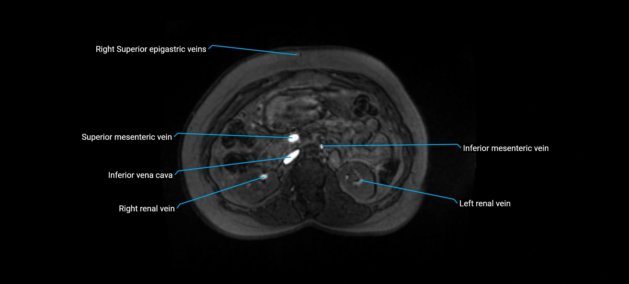 MRV abdomen pelvis & lower limb axial cross sectional anatomy labelled MRI image 71 (1).webp